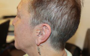 Auricular acupuncture